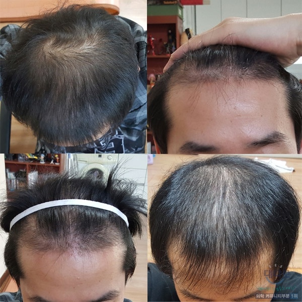 이게 대략1년정도전쯤에 병원에 문의할때 사진입니다.