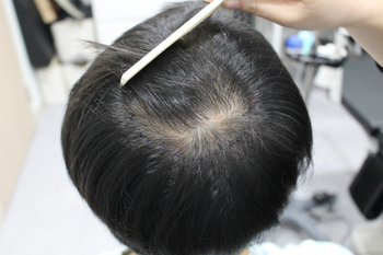 수술 전 1