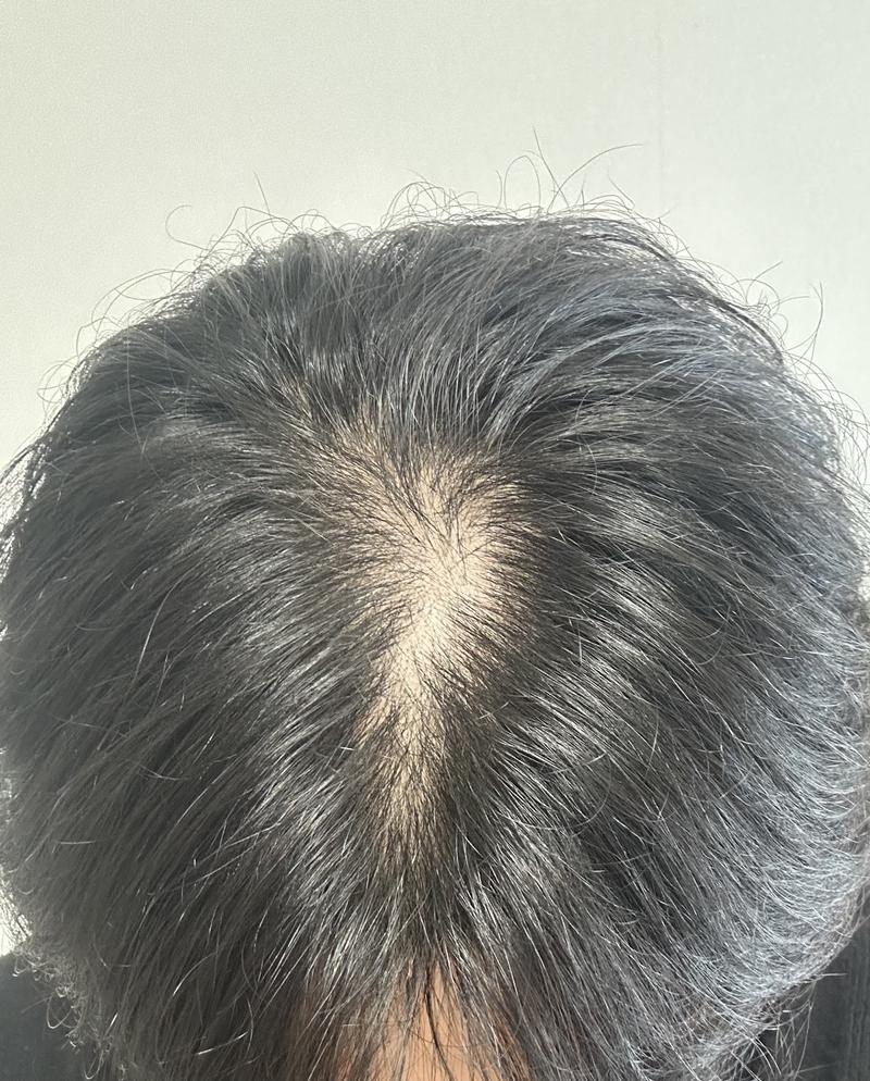 판시딜 먹고 있는데.. 탈모약 먹어야할까요?