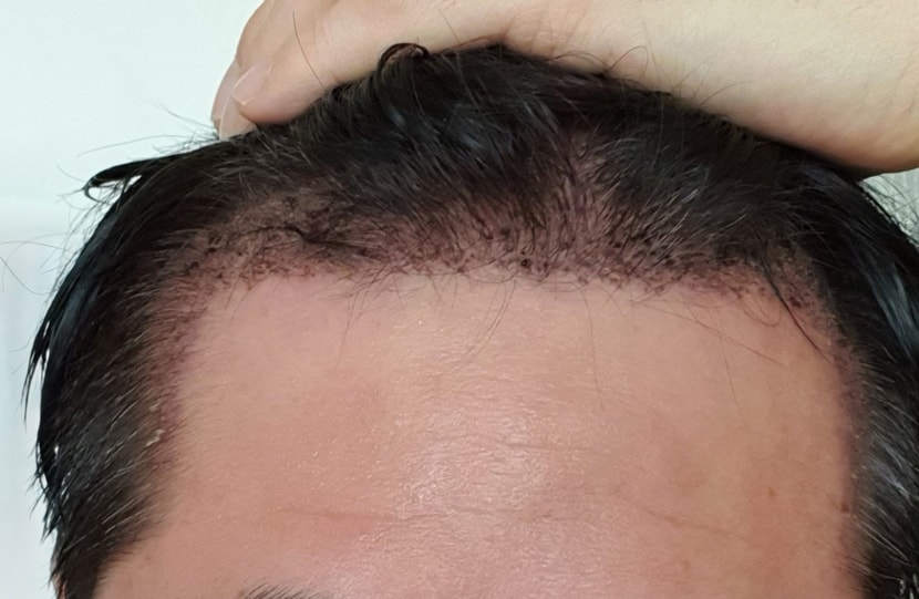  - 수술 2일 차 M자 부위-    M자 부위와 전두부 앞쪽 이식 부위에 검은 점 같은 딱지로 조금씩 변하는 것 같습니다. 