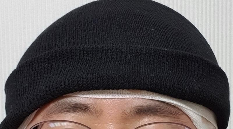 비절개, 무삭발 형식의 모발이식 후기