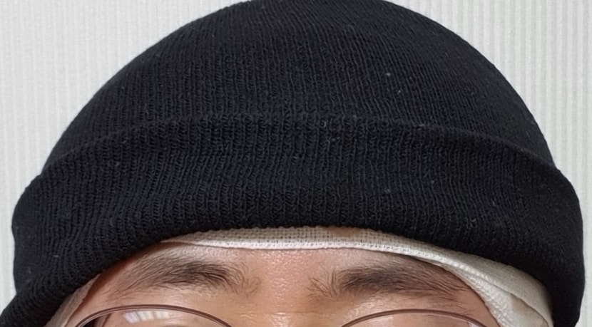  - 수술 당일 정면-     수술 직후 머리에 붕대 감고 비니모자 쓰고 자기 차량으로 직접 운전하여 집으로 왔습니다.