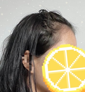 여기까지가 모발이식 전 사진이에요