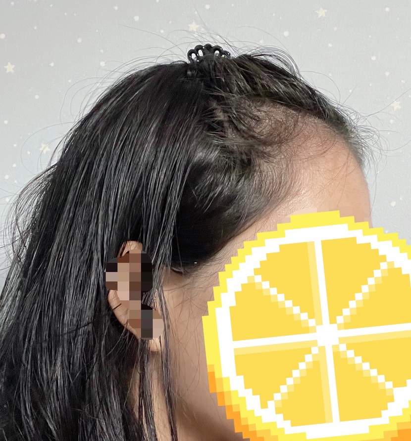 여기까지가 모발이식 전 사진이에요