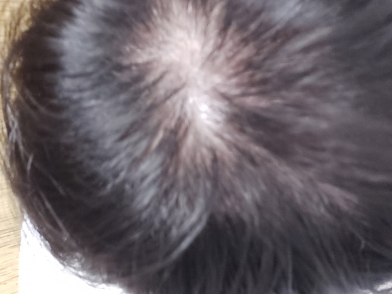 신세한탄) 18세에 발병해서 7년째 탈모입니다