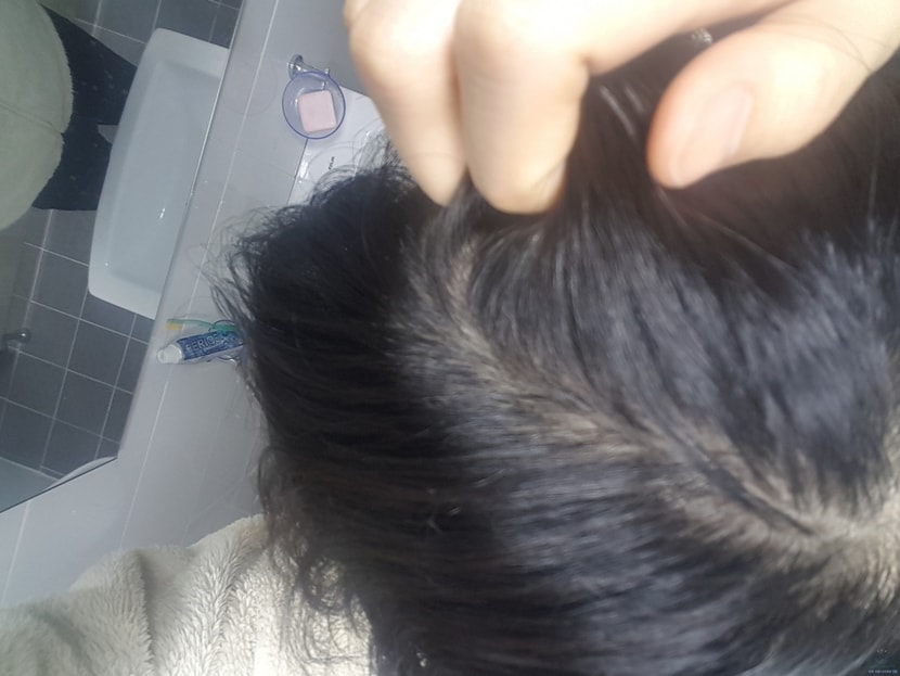 16년 12월 첫 탈모발견 탈모확정 ㅠㅠ