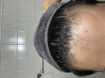 전체 이마 
