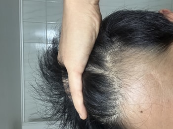 말린후 왼쪽 이마 