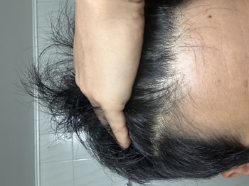 말린후 오른쪽 이마 