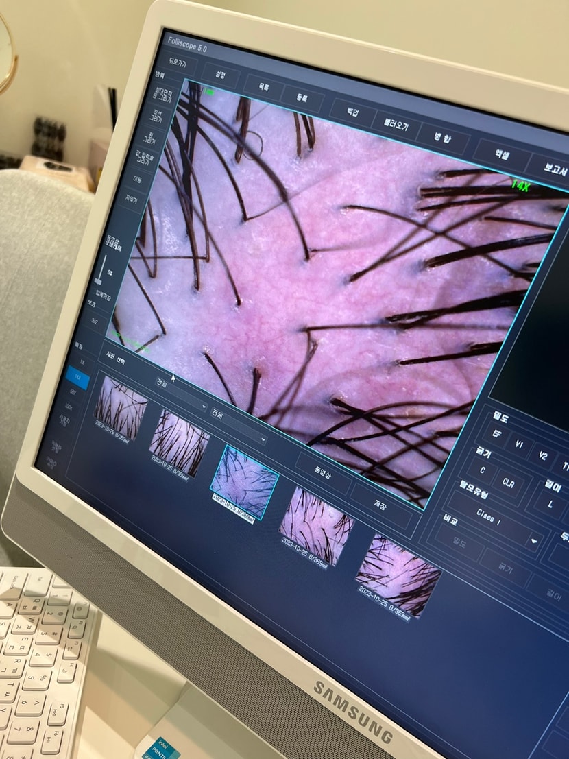 어제 병원갔다가 찍은사진입니다... 모낭에 한가닥씩만 난다고하네요