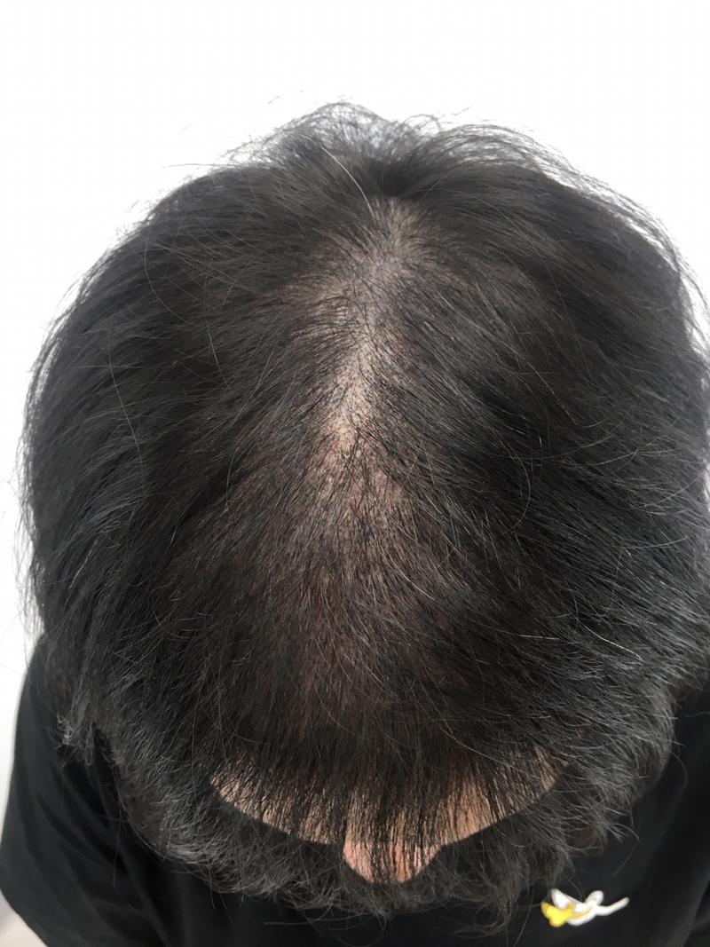 Exosome Botox hair loss treatment