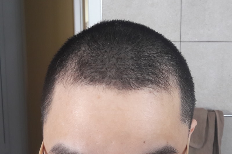 m자 탈모 진행 상황입니다. 미녹시딜 효과가 있을까요?