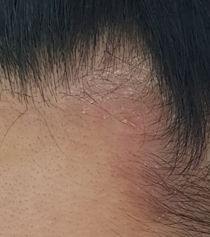 3개월 후 오른쪽 부분 디테일 샷
