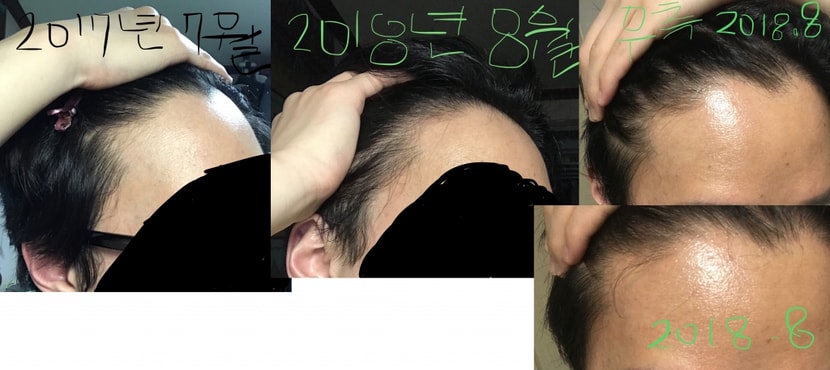 이마 우측 사진, 2017년 7월 vs 2018년 8월 3장