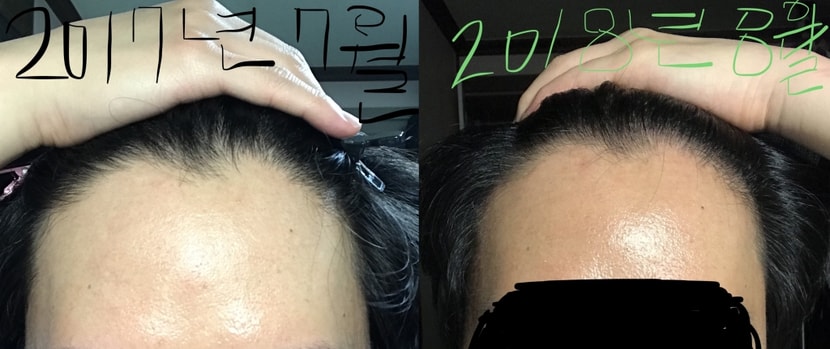 이마 정면 사진. 2017년 7월, 2018년 8월 비교