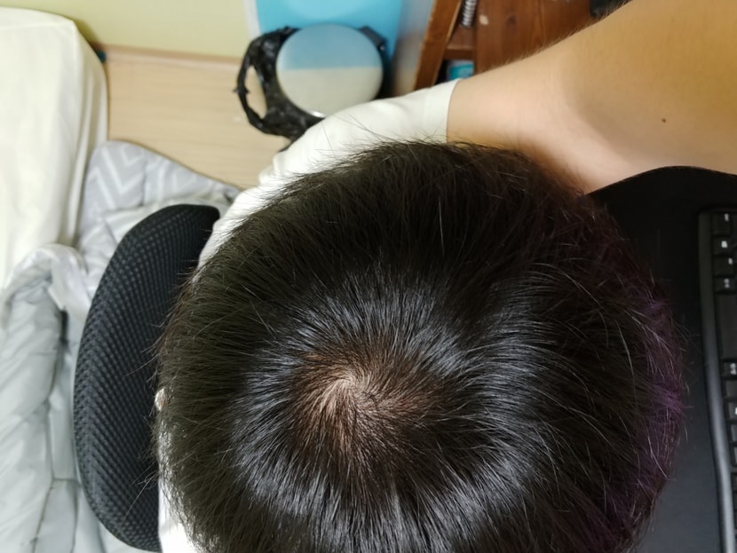 방금찍은 사진 복용 3개월 조금 넘음