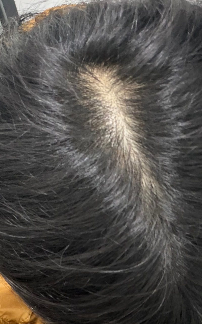 頭頂部の脱毛でしょうか