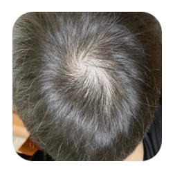 약 복용전 (중학교때부터 이정도)