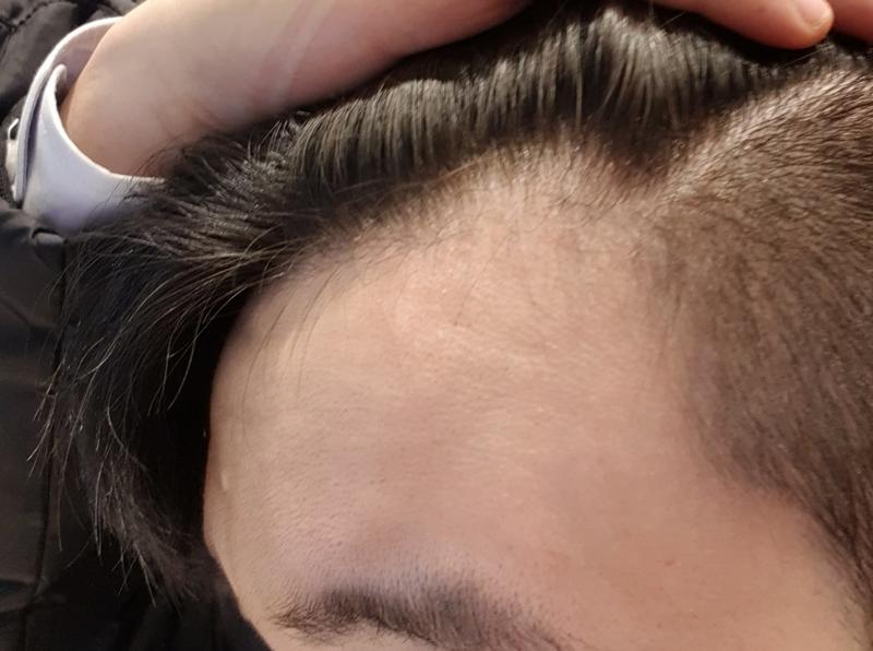 那个m型脱发吗？ 要打头阵吗？