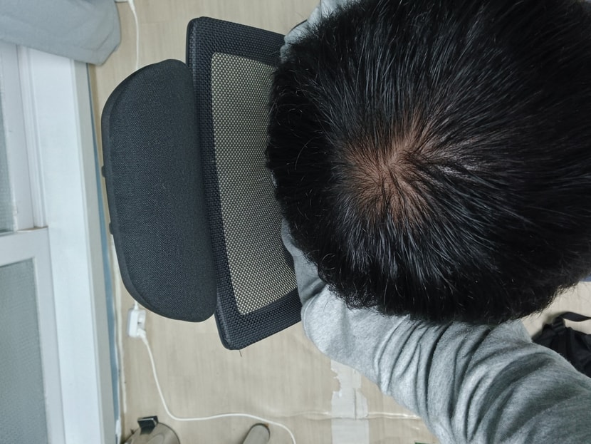 2월 미녹시딜을 이때쯤 시작했을 겁니다