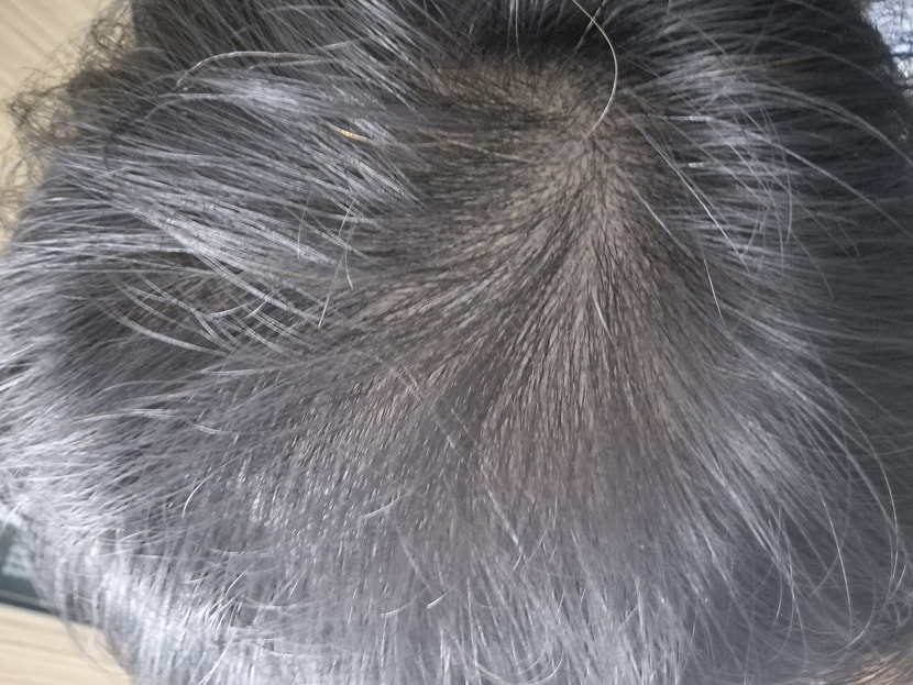 탈모심해지고있네요 맘이아픕니다.
