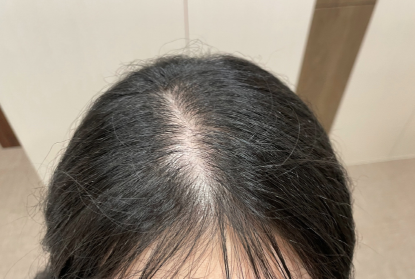 시술 전 사진