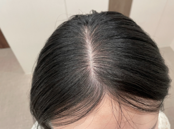 탈모주사 패키지 2회차