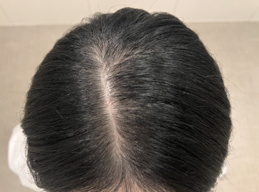 메조테라피 1회차 후