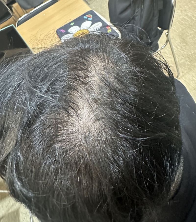 대구 쌍가마 정수리 탈모치료 효과 본거 같아요