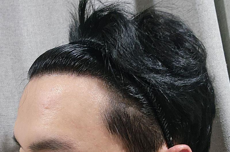 포헤어 10개월차 헤어라인 밀도