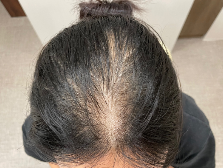 정수리 사진 보니 안습이네요ㅜ