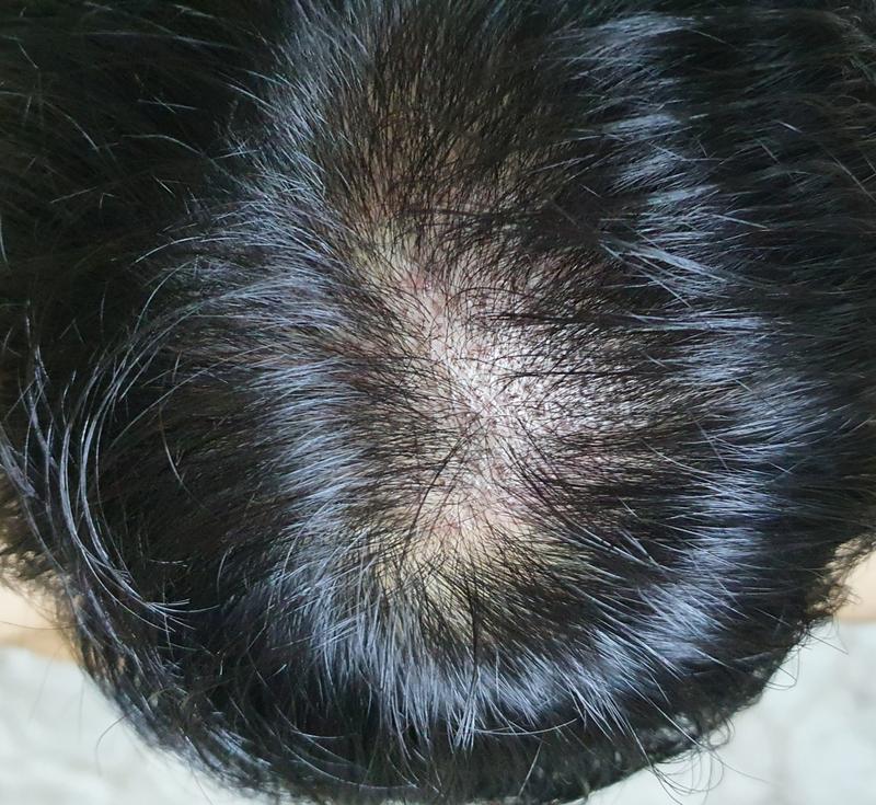 모낭주사 (엑소좀+보톡스+성장인자) 탈모치료 1회차