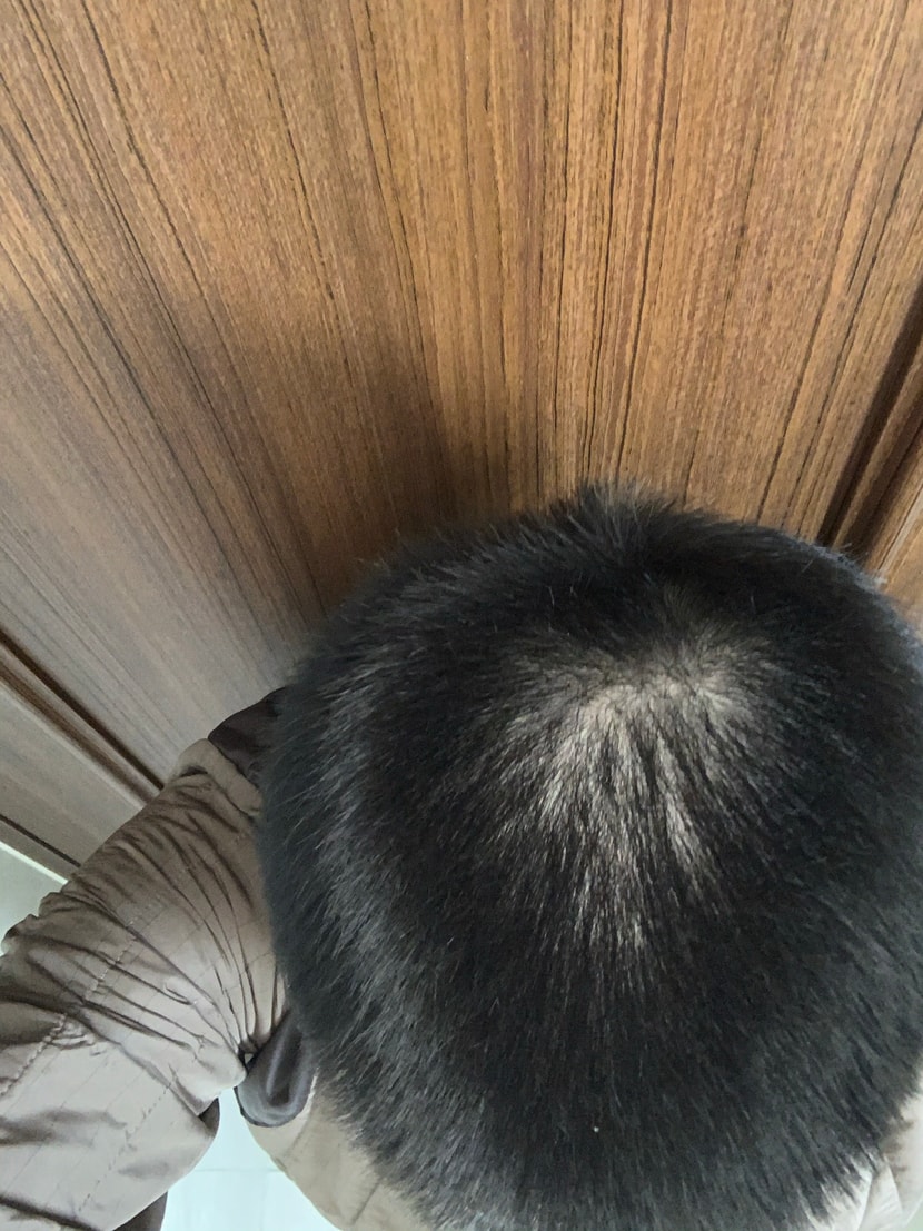2월 (약복용 시작)