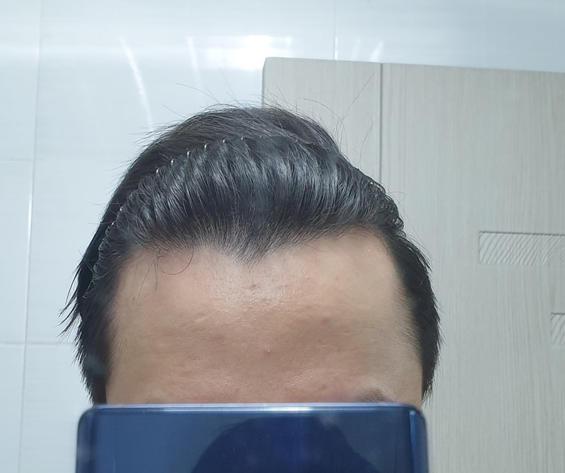 M字第8个脱发记录（21.06.23）