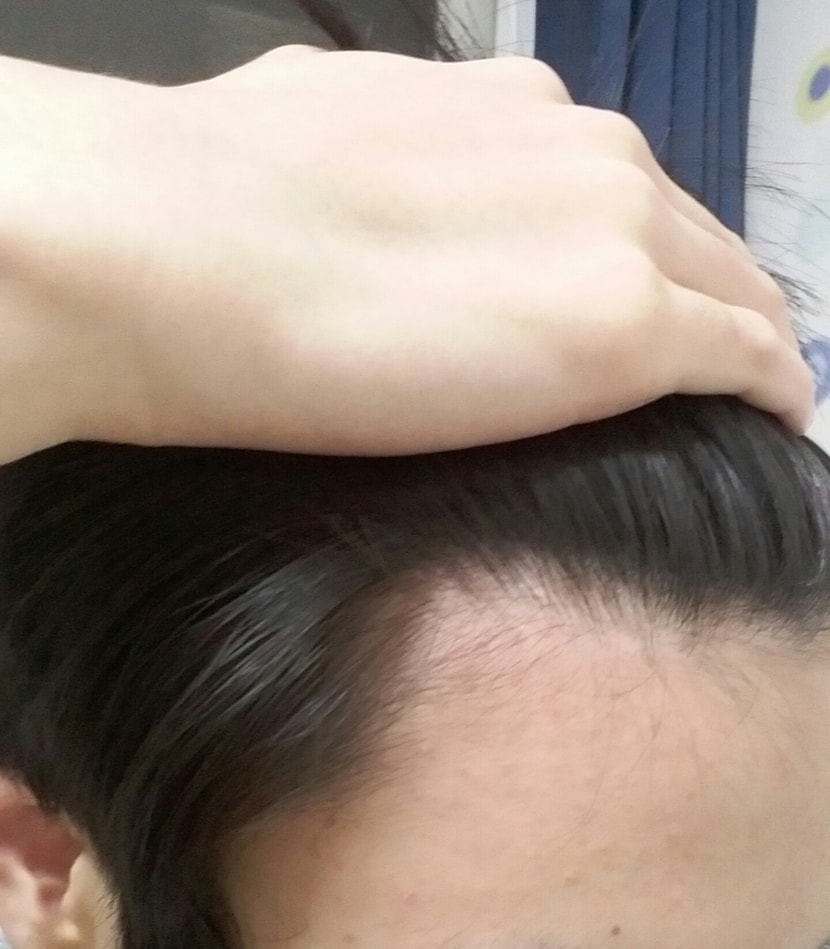친구가 이곳을 보며 저에게 탈모라 했습니다
