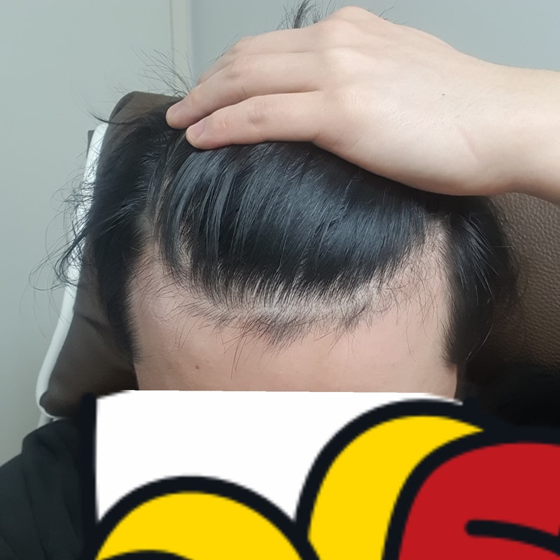 피나모아 처방 받고 오는길입니다. (탈모약 첫 시작..!) PS.궁금한점 질문입니다.