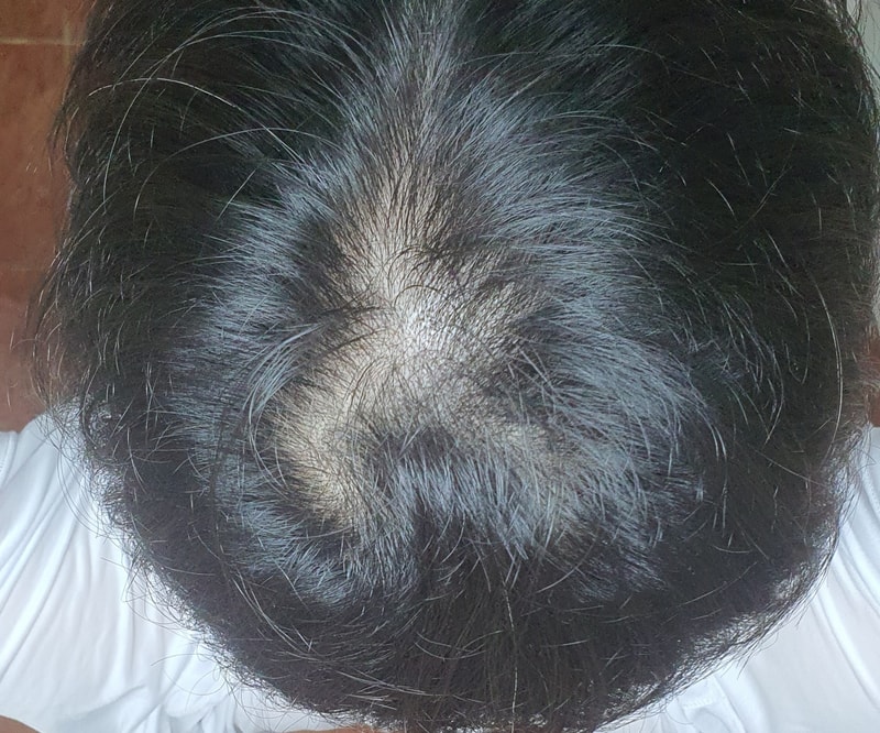 頭頂部脱毛判定···..