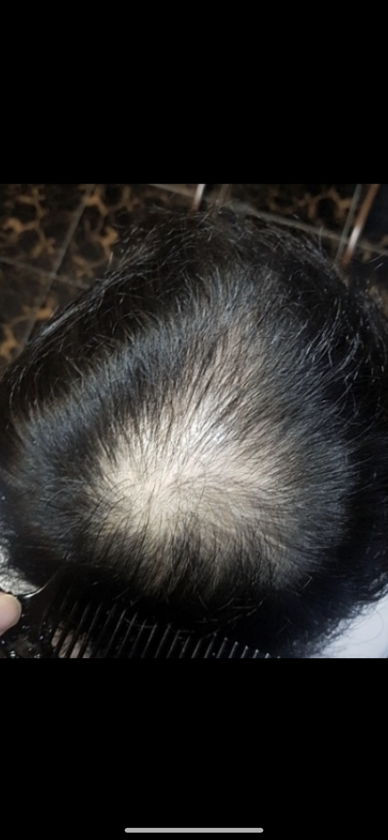 약+미녹 19개월 어때보이시나요?