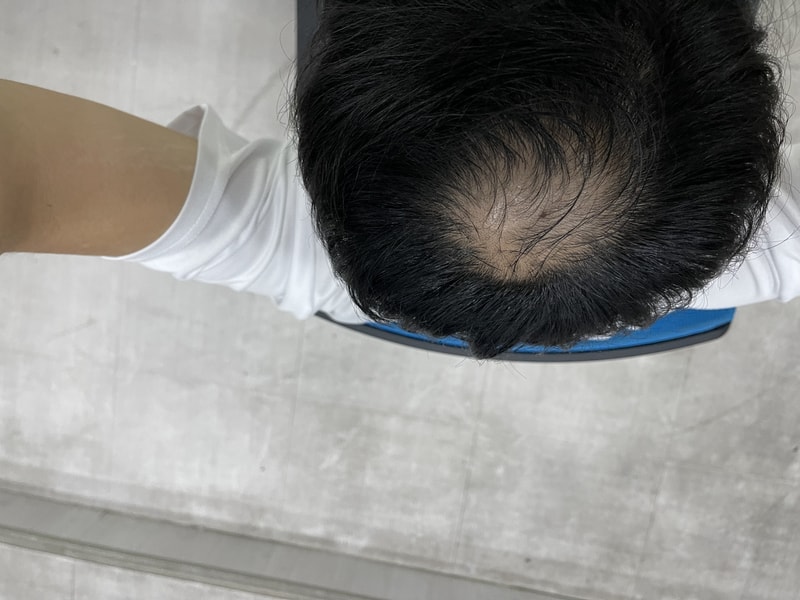 하 탈모약 탈모진행상황 푸념글 …