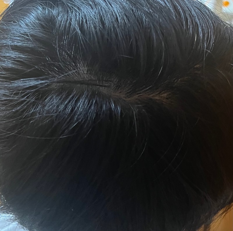 服用脱发药一年又半年？ 好像差不多了。jpg