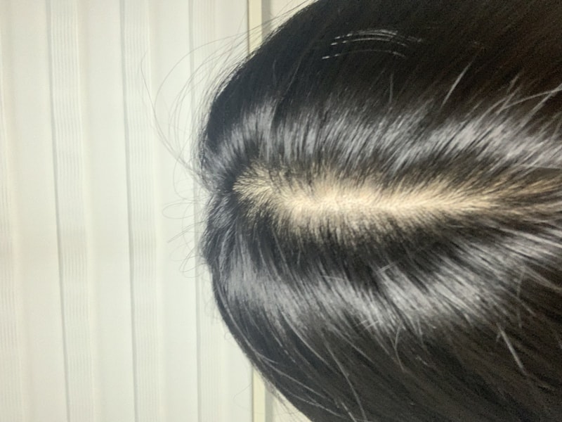 是中分脱发吗？