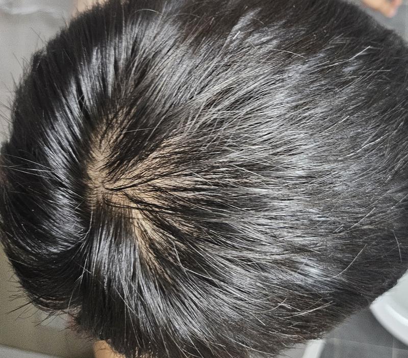 薄毛の診断を受ける方法？