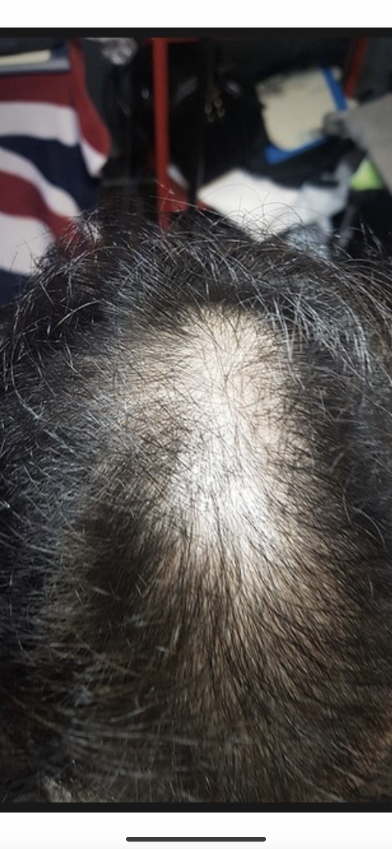 약+미녹 18개월 어때보이시나요?