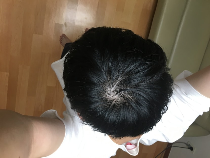 지루성 두피염으로 인해 약 바르고 난 후
