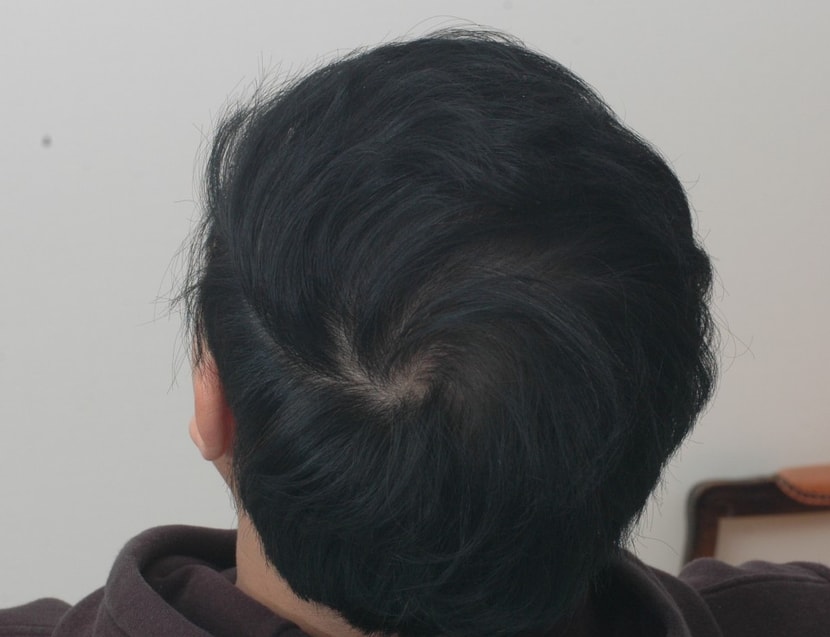 수술후1년