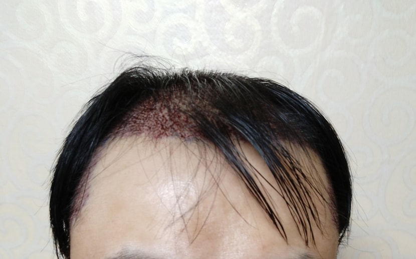 수술당일 밀도상태