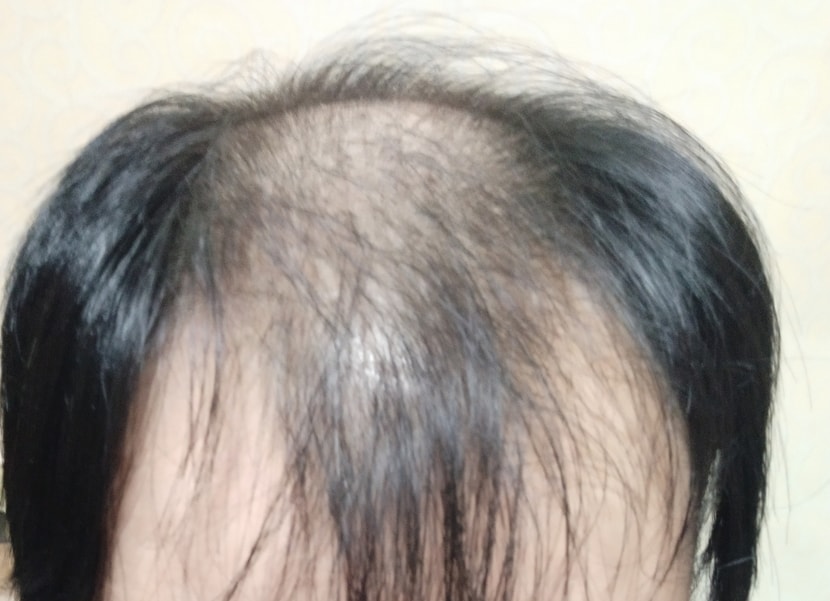 수술전