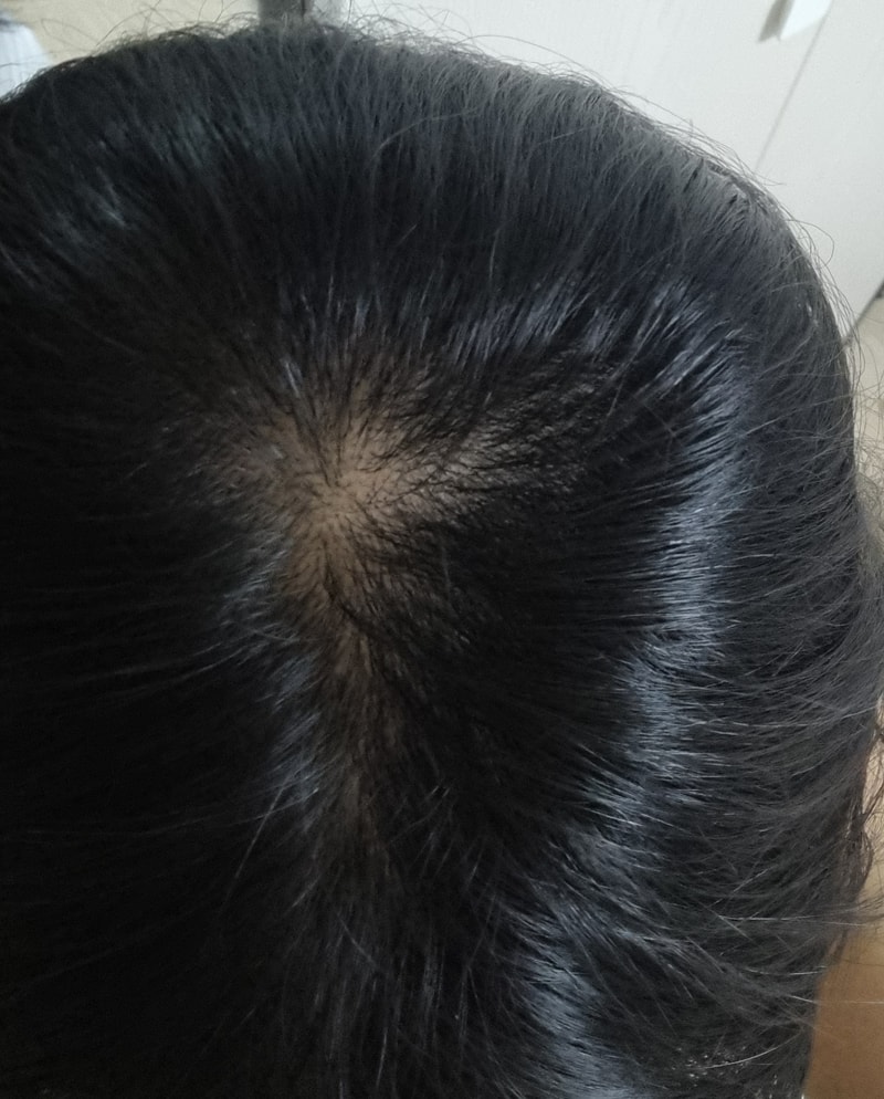 이거 탈모입니까????