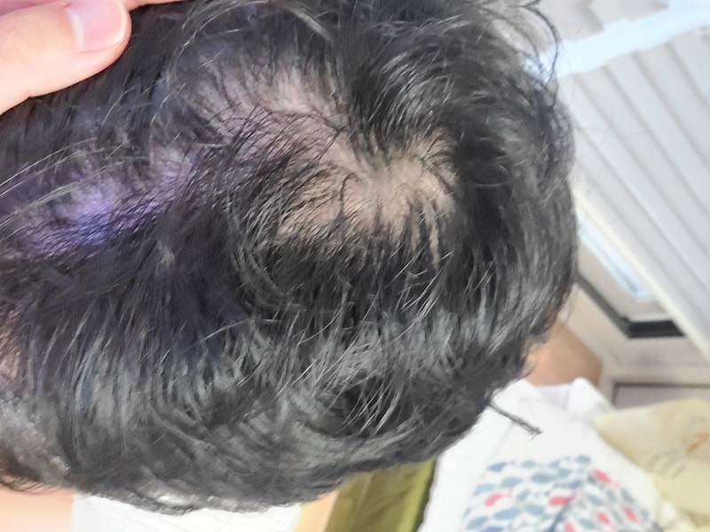 상두부 탈모때문에너무 스트레스 받는데요