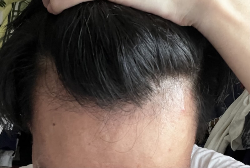 フィナステリド服用8ヶ月目なのに